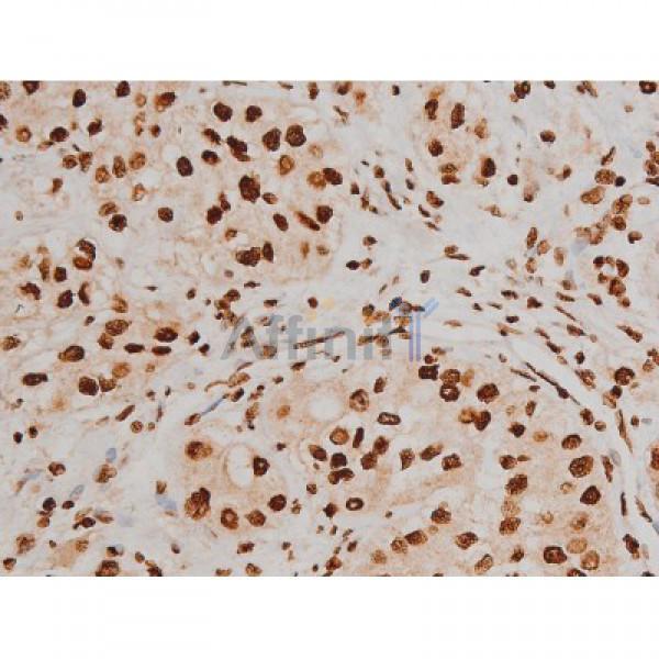 Phospho-Ezrin (Tyr353)[Tyr354] Antibody - AF3173 at 1/200 staining Human kidney cancer tissue sections by IHC-P.